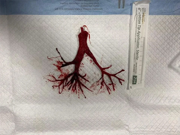 Intact-Blood-Clot-Terminally-Extubated-Covid-Patient-600.jpg