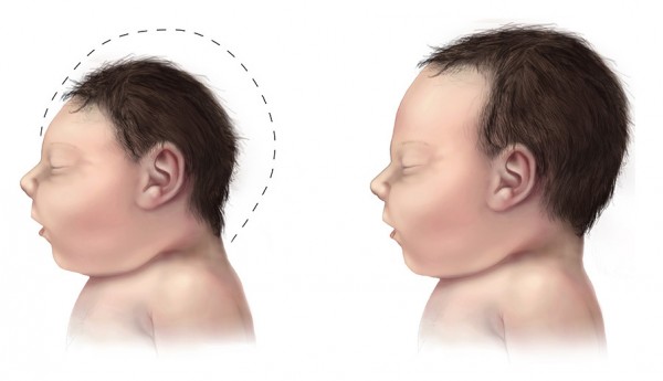 Image: Government document confirms vaccine link to microcephaly