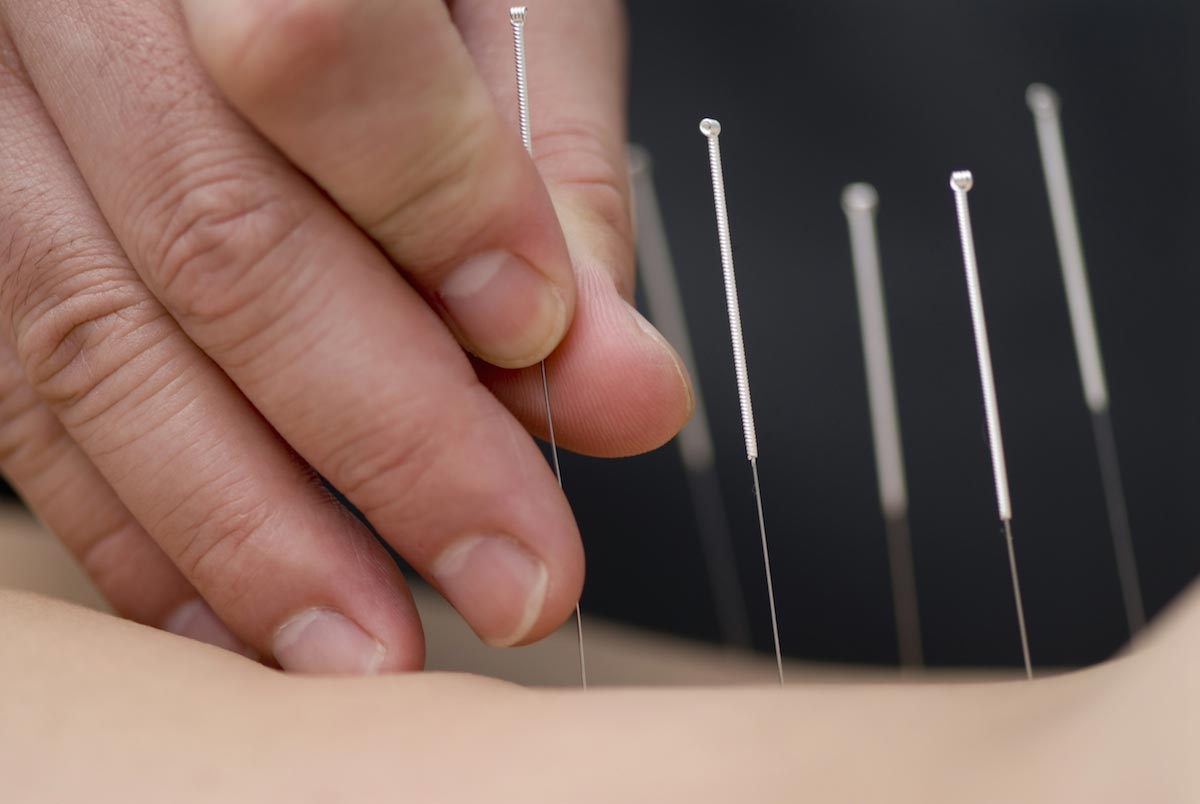 Image: Acupuncture found to help treat men with erectile dysfunction and fertility issues