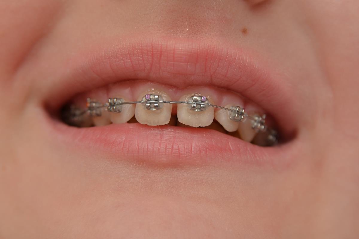Image: Kids are doing DIY braces on YouTube and the results are scary