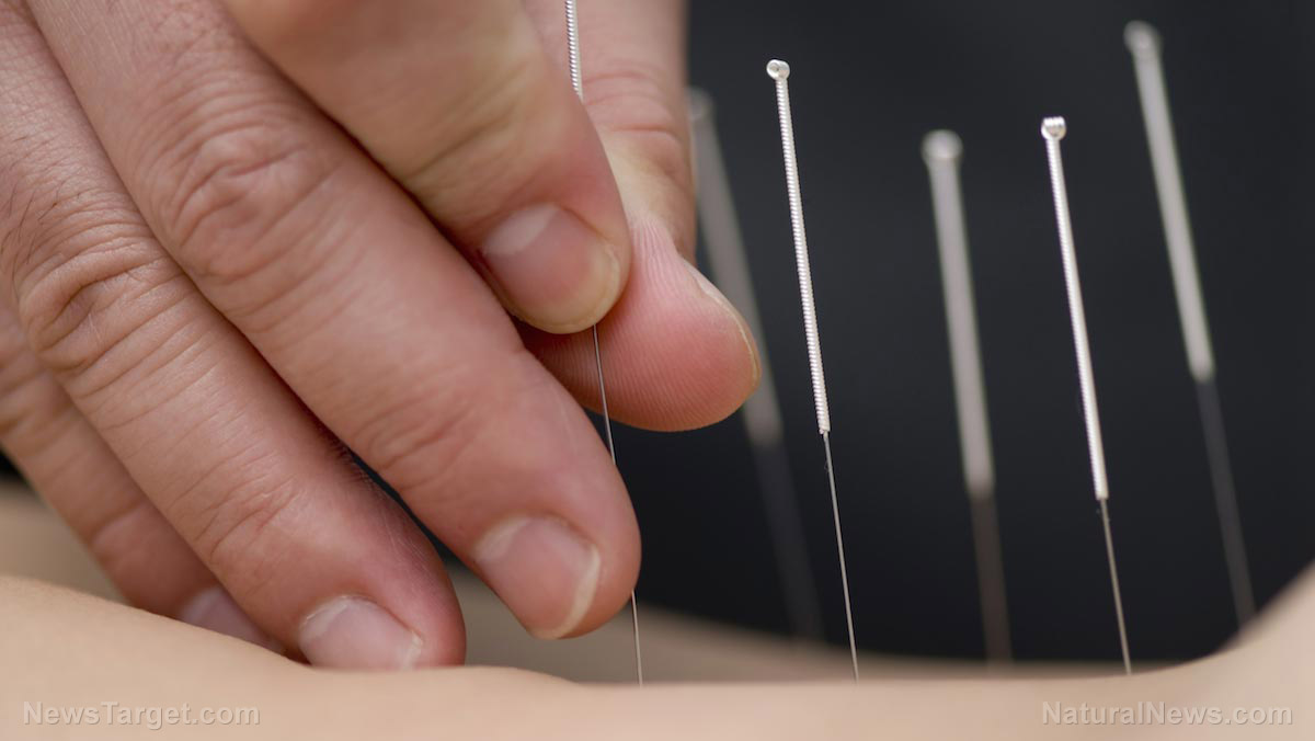 Image: Arthritic pain can be reduced with sinew acupuncture