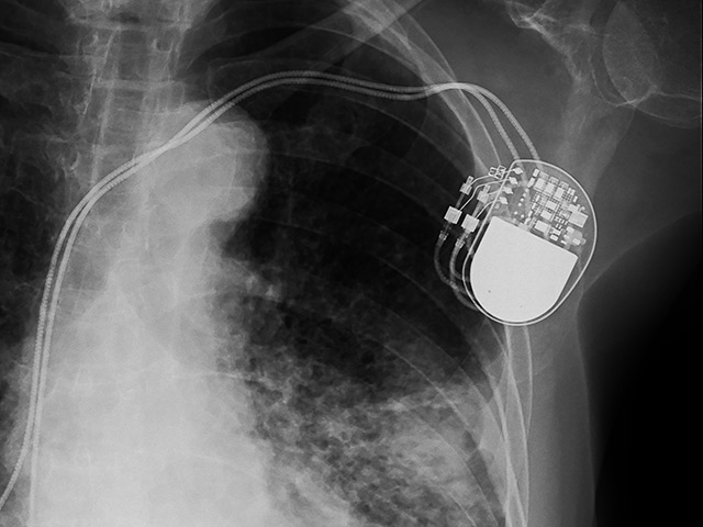 Image: Man’s pacemaker may ultimately land him in jail in for arson and insurance fraud