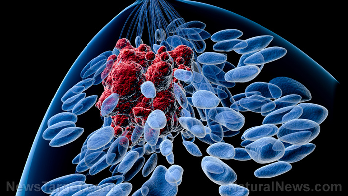 Image: Study: Cancer cells thrive in stiffer tissue