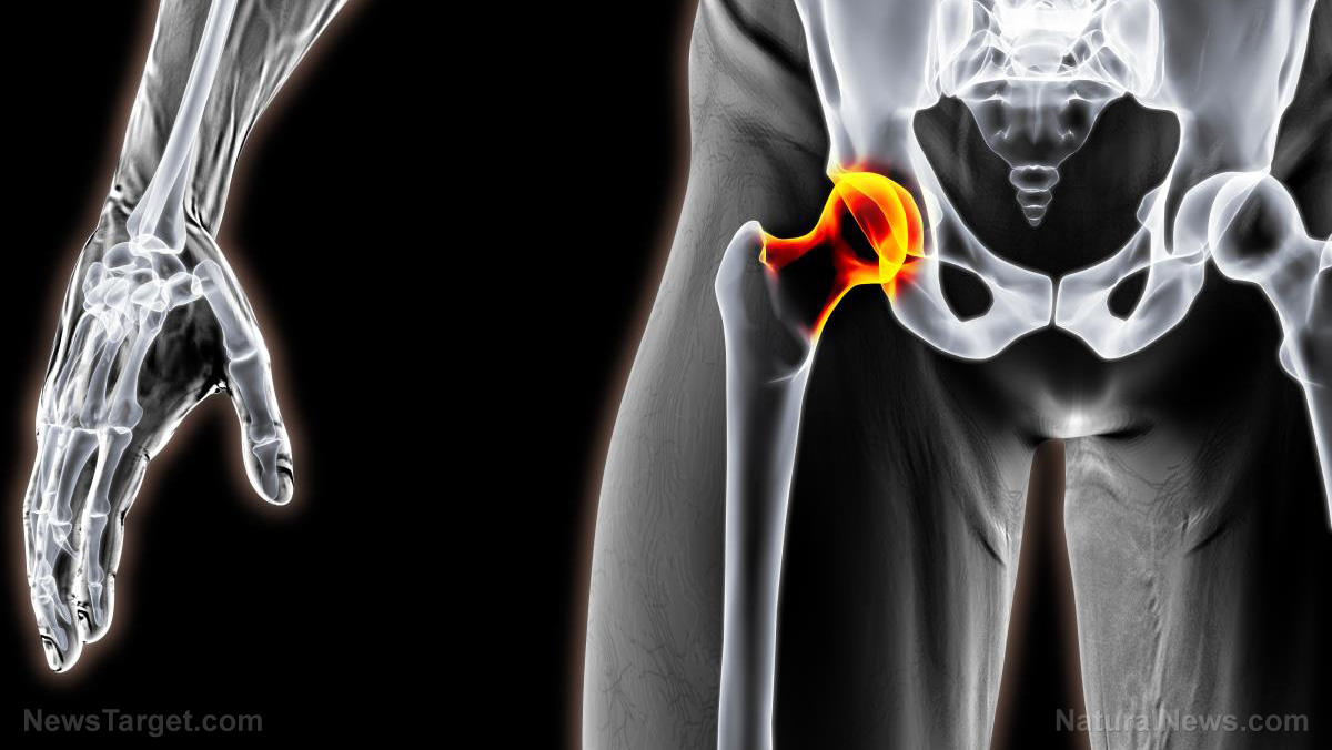 Image: Toxic metals in hip replacements found to cause Alzheimer’s