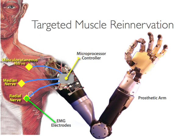 Image: Limb regeneration: Scientists have discovered that the human brain can remap nerves and motor pathways to artificial limbs