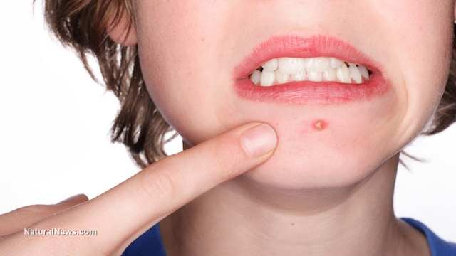Image: Acne and eczema might be curable by rubbing probiotics on your skin