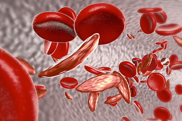 Image: Sickle cell disease can be naturally remedied with bleeding-heart herb