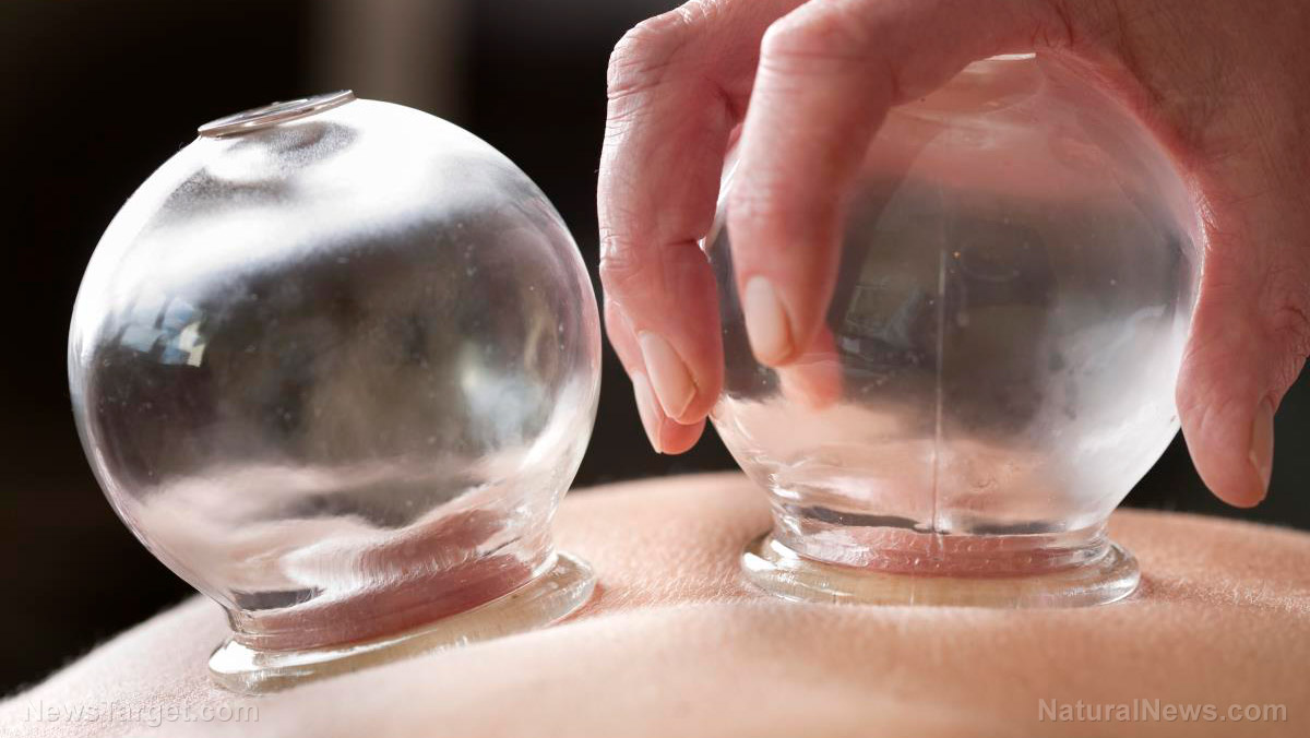 Image: Do you suffer from chronic neck pain? Try cupping, an ancient form of alternative medicine