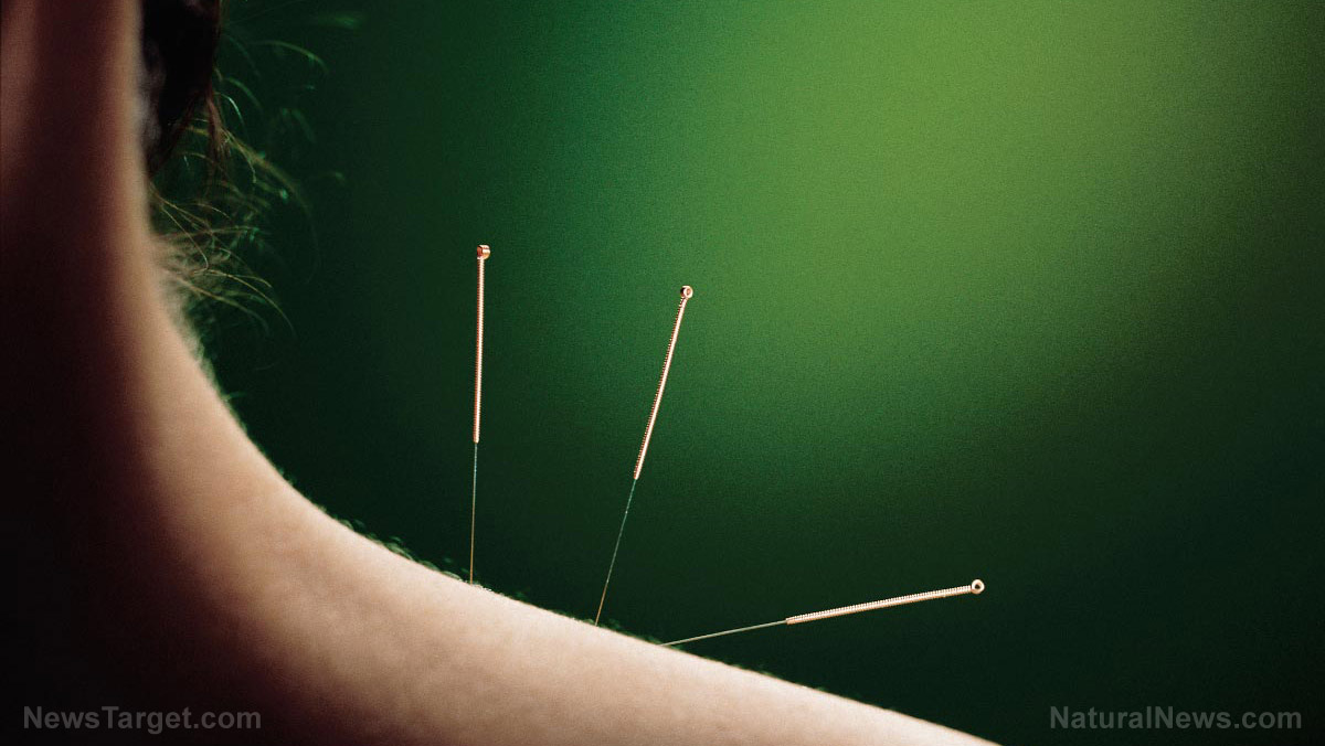 Image: Systematic review finds acupuncture to be highly effective at treating anxiety disorders
