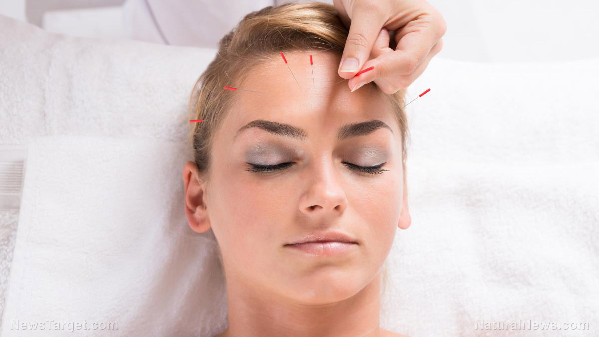 Image: Yes, you can use acupuncture to improve skin conditions