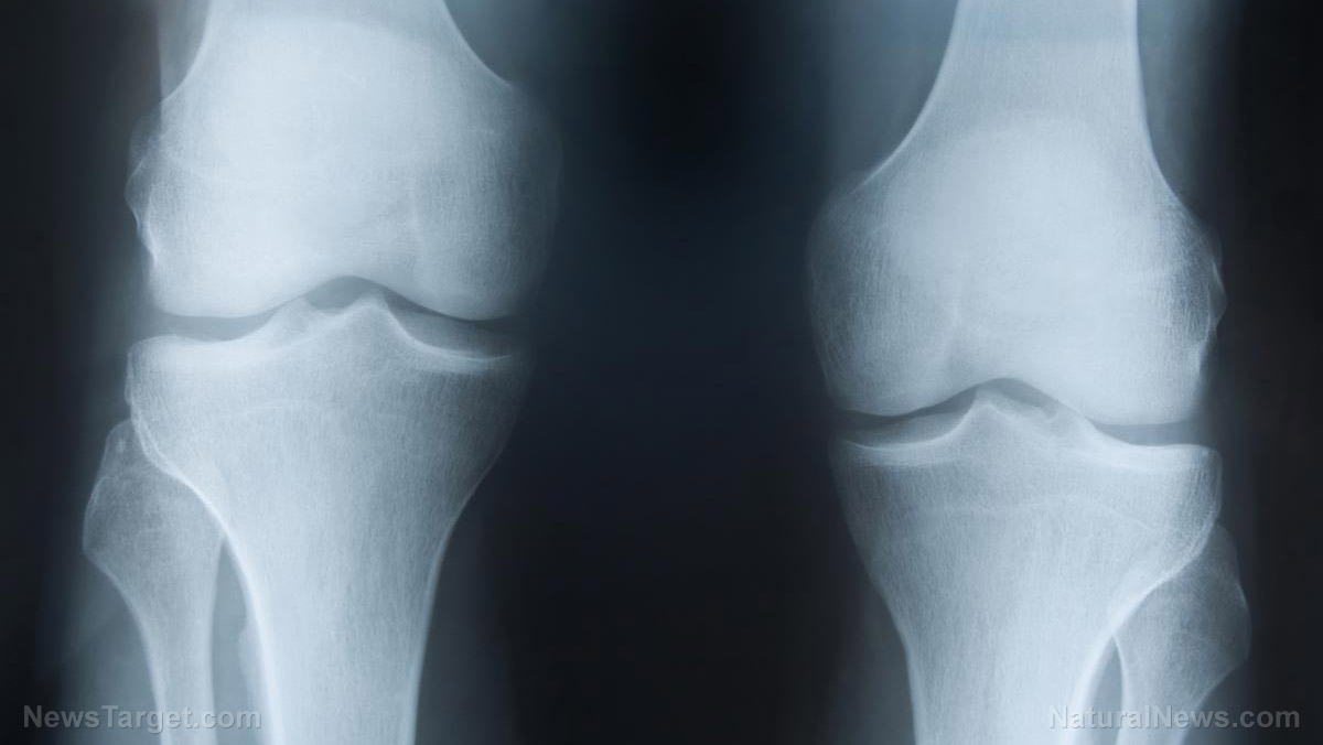 Image: Having “noisy knees” increases your risk of developing osteoarthritis, study concludes