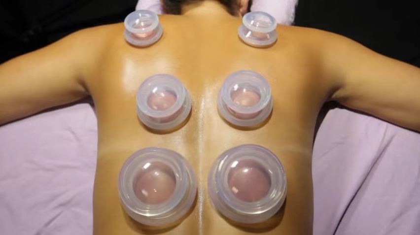 Image: Research shows that wet cupping therapy can improve musculoskeletal pain