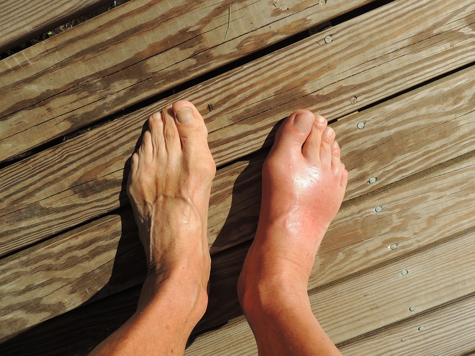 Image: Gout: Another metabolic disorder that can be controlled through lifestyle