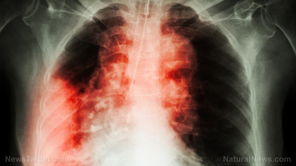 Image: Cancer treatments HARM patients: Radiotherapy can cause aggravated lung injury – study