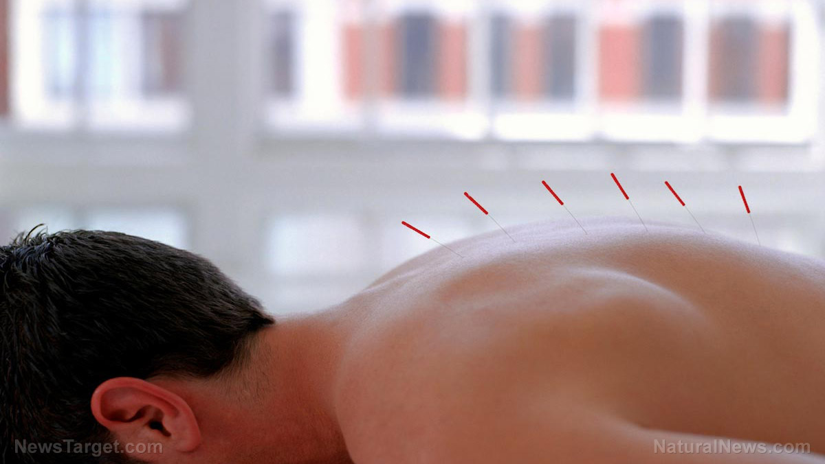 Image: Acupuncture found to calm heart rate, increase stamina in athletes engaging in high-intensity training
