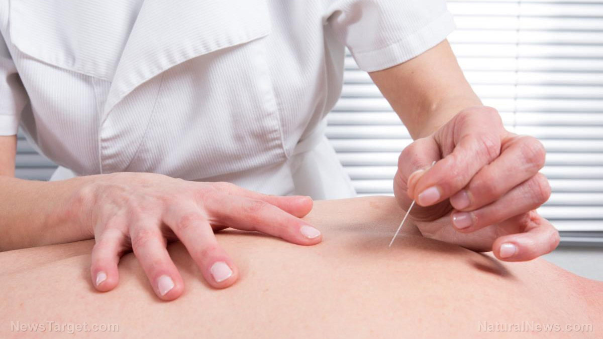 Image: Before you reach for pain medication, have you considered acupuncture?