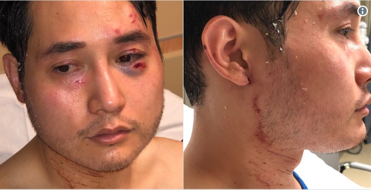 Image: Domestic terrorism in Portland: Indy journalist Andy Ngo attacked with chemical-laced quick-drying cement as mayor, police do NOTHING