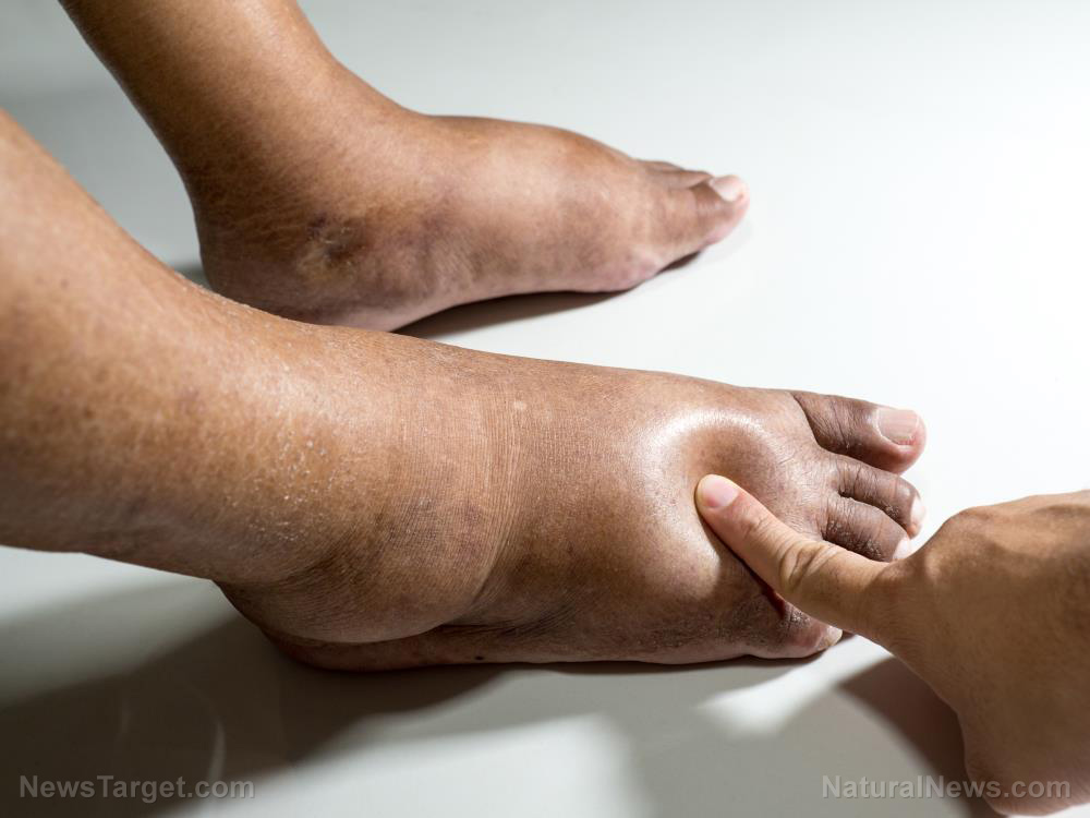 Image: Better together: Case study reveals how a combination of Ayurveda and allopathy helped in treating diabetic foot