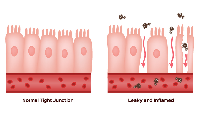 Image: A silent killer: Leaky gut syndrome is often misdiagnosed or ignored