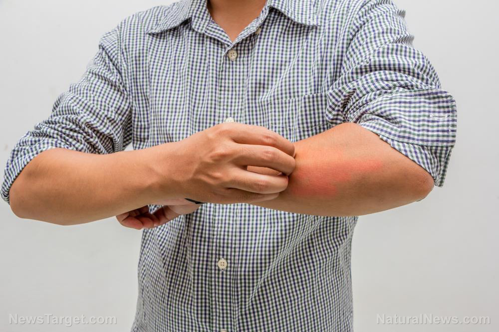 Image: Your itchy skin may indicate a kidney condition; research finds a connection