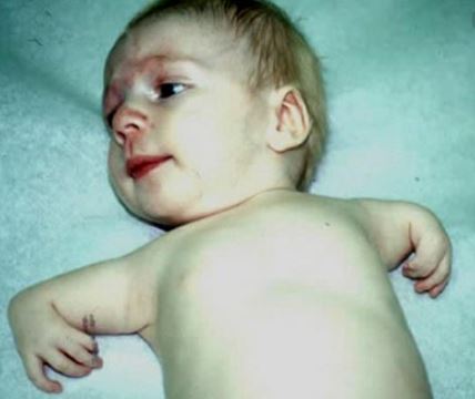 Image: Expect thousands of US babies to be born with birth defects if their carrying mothers get injected with a thalidomide-laced covid vaccine