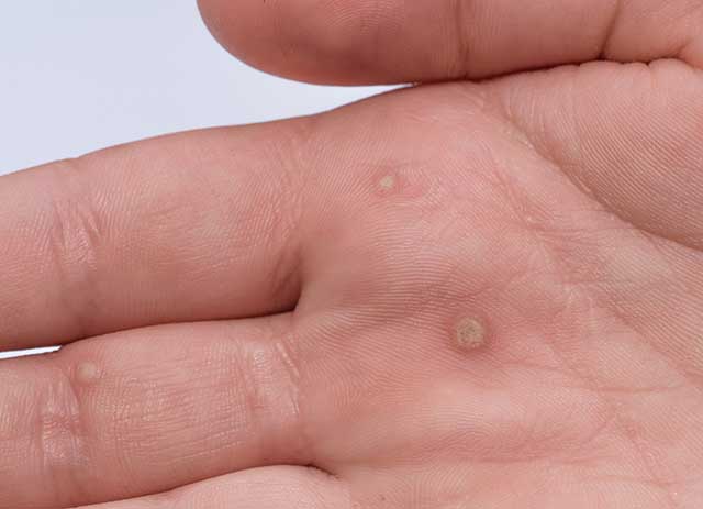 Image: Warts: Causes and 10 natural remedies