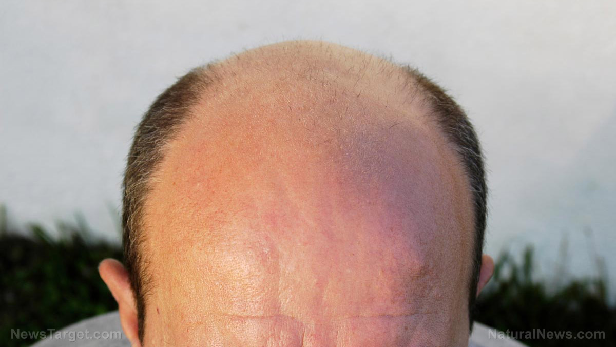 Image: Want to go bald? Get a covid “vaccine!”
