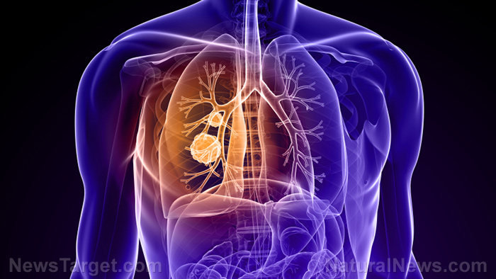 Image: Jingfukang: The TCM herbal medicine that stops lung cancer in its tracks