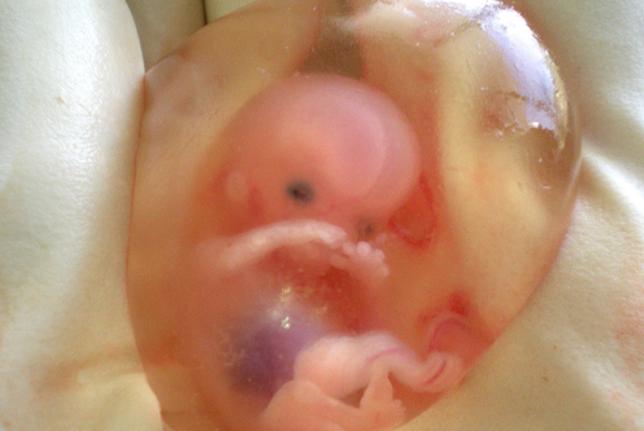 Image: Abortion industry pushing chemical pill to starve unborn in womb as fears rise SCOTUS will overturn Roe v. Wade