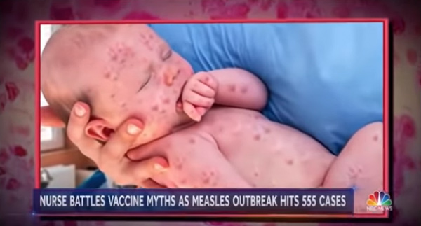 Image: Measle-infected baby photos FAKED by NBC News to push mass hysteria and demand vaccine compliance