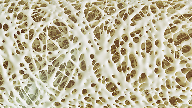 Image: Osteoporosis myths DEBUNKED: Truths about bone health