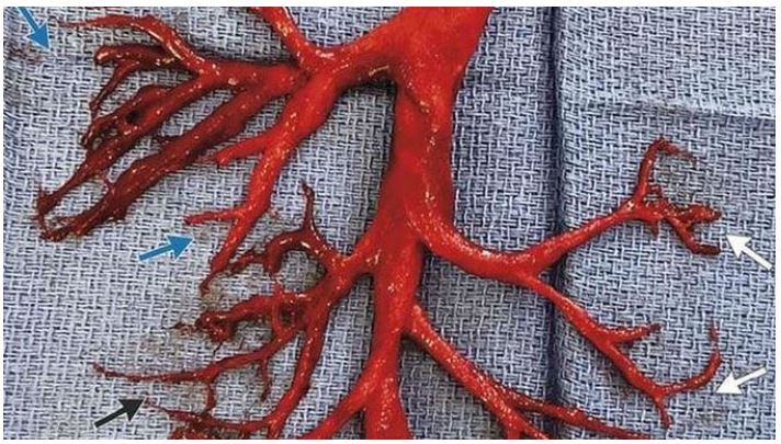 Image: Post-mortem examinations find massive blood clot biostructures in bodies of the vaccinated