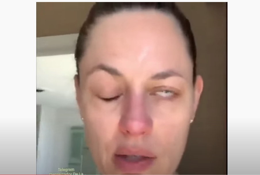 Image: Canadian actress suffers from Bells Palsy after taking COVID jab, but says she would “do it again” because “it’s what we have to do”