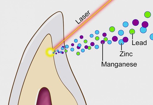 DISTURBING: Scientists use lasers to discover baby teeth of children with AUTISM contain shockingly high levels of HEAVY METAL TOXINS