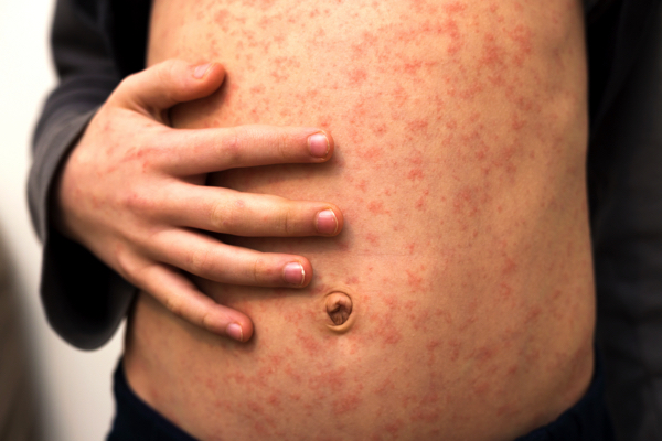 MEASLES HYSTERIA: A manufactured crisis to push Big Pharma profits