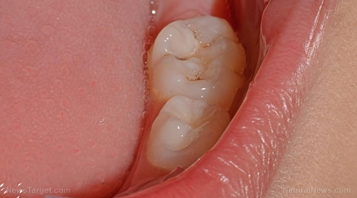 The silent threat: How oral bacteria linked to gum disease fuel cancer and endanger the heart