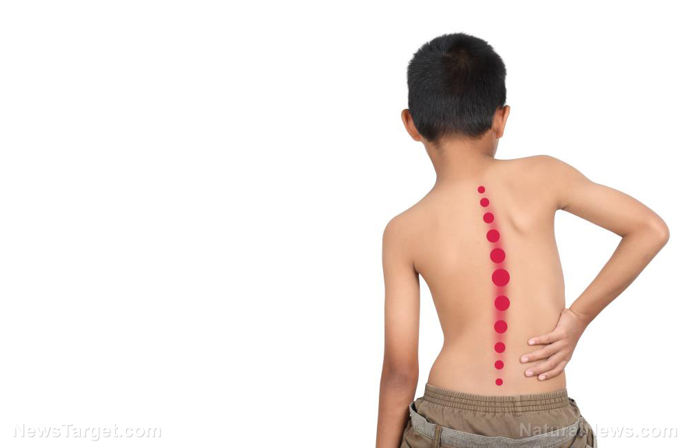 Beyond the curve: Early detection and holistic care change the trajectory of scoliosis