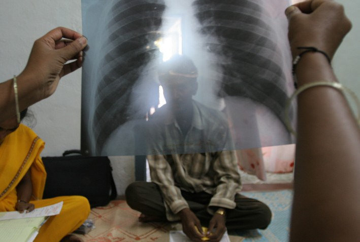 The silent shield: How strategic nutrition protects patients from tuberculosis drug side effects