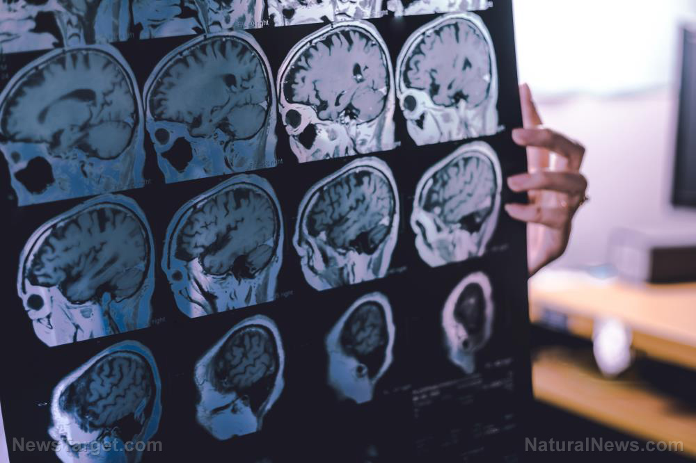 Nearly half of dementia cases could be prevented through lifestyle changes, experts reveal